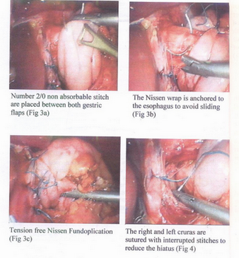 Transition from open to laparoscopic Nissen fundoplication